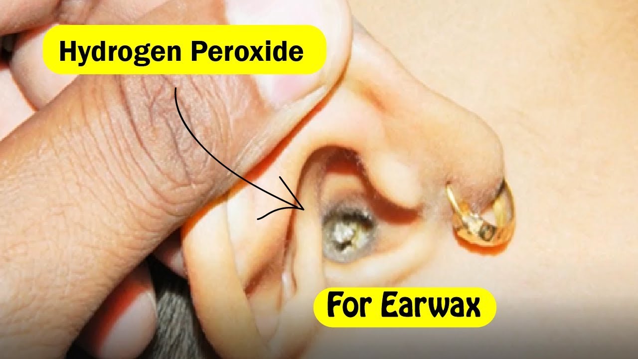 Using Hydrogen Peroxide For Earwax Removal: Safe Or Not?