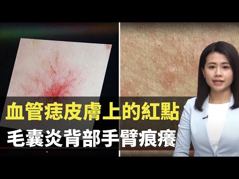 血管痣皮膚上的紅點  毛囊炎背部手臂痕癢-    最強生命線 - 香港新聞 - TVB News- 黃靖婷